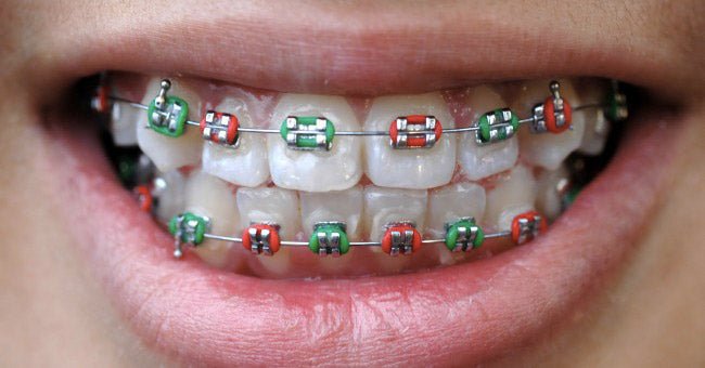 Orthodontie à l’école : la routine “école-proof” pour bagues & aligneurs - Nana Brush
