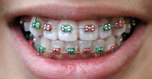 Orthodontie à l’école : la routine “école-proof” pour bagues & aligneurs - Nana Brush