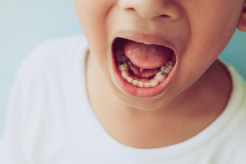 Rentrée : prévenir les caries liées aux écrans et encas - Nana Brush